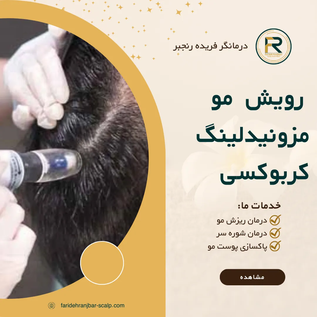 روش‌های درمانی برای رویش مجدد مو مزونیدلینگ و کربوکسی