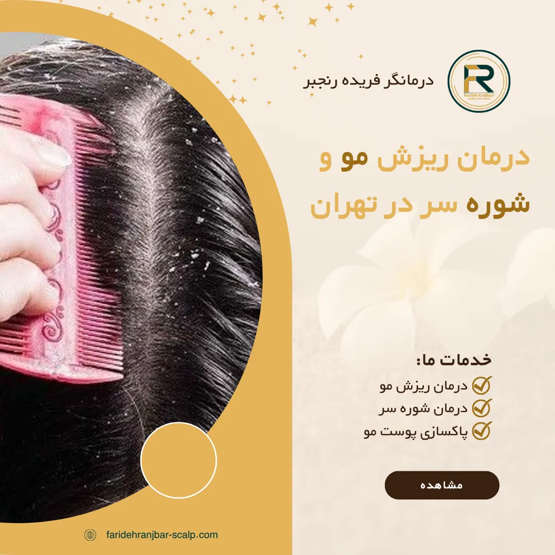 درمان ریزش مو و شوره سر در تهران