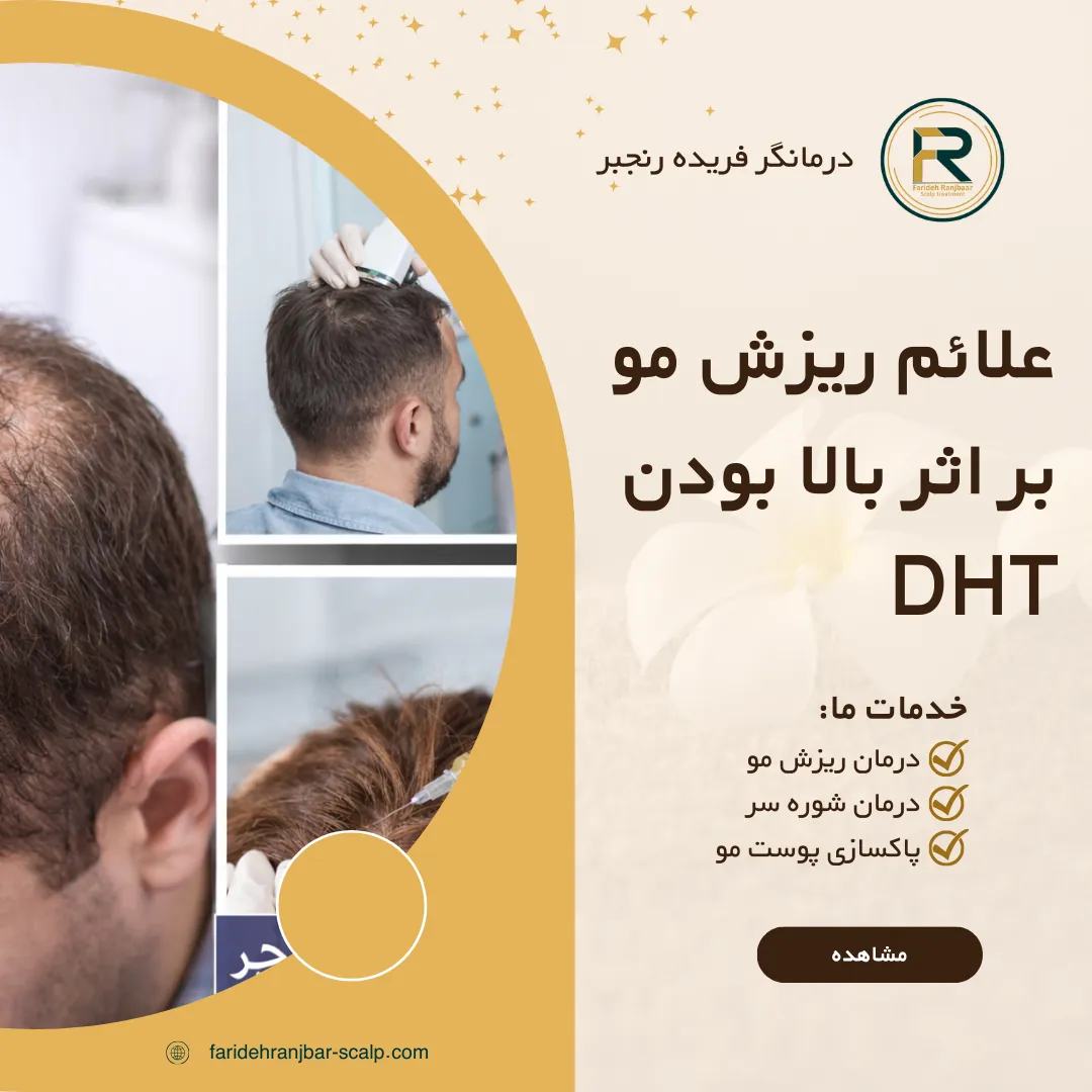 علائم ریزش مو بر اثر بالا بودن DHT؛ نشانهها، دلایل و راههای کنترل آن